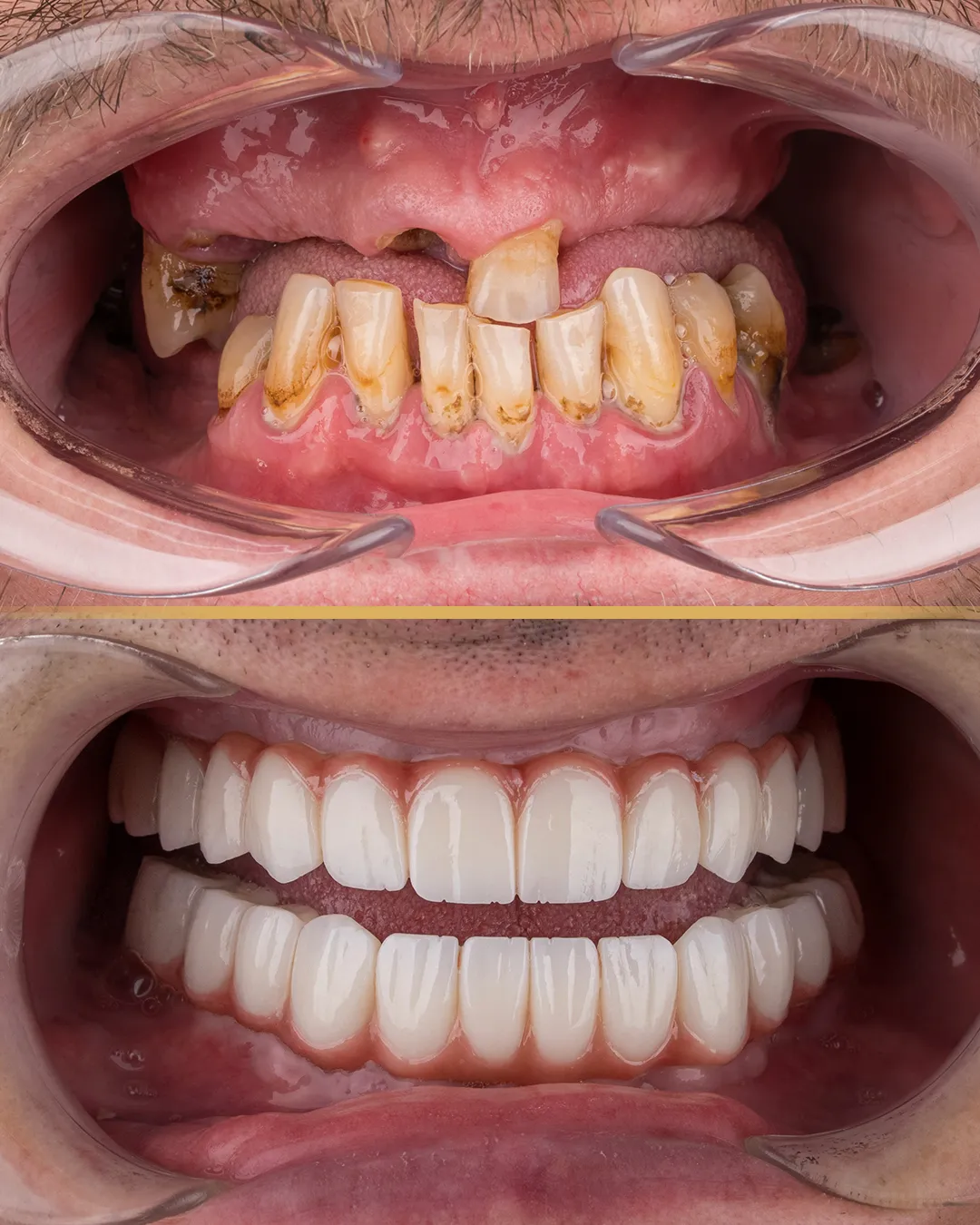 All on 4 Dental Implants3
